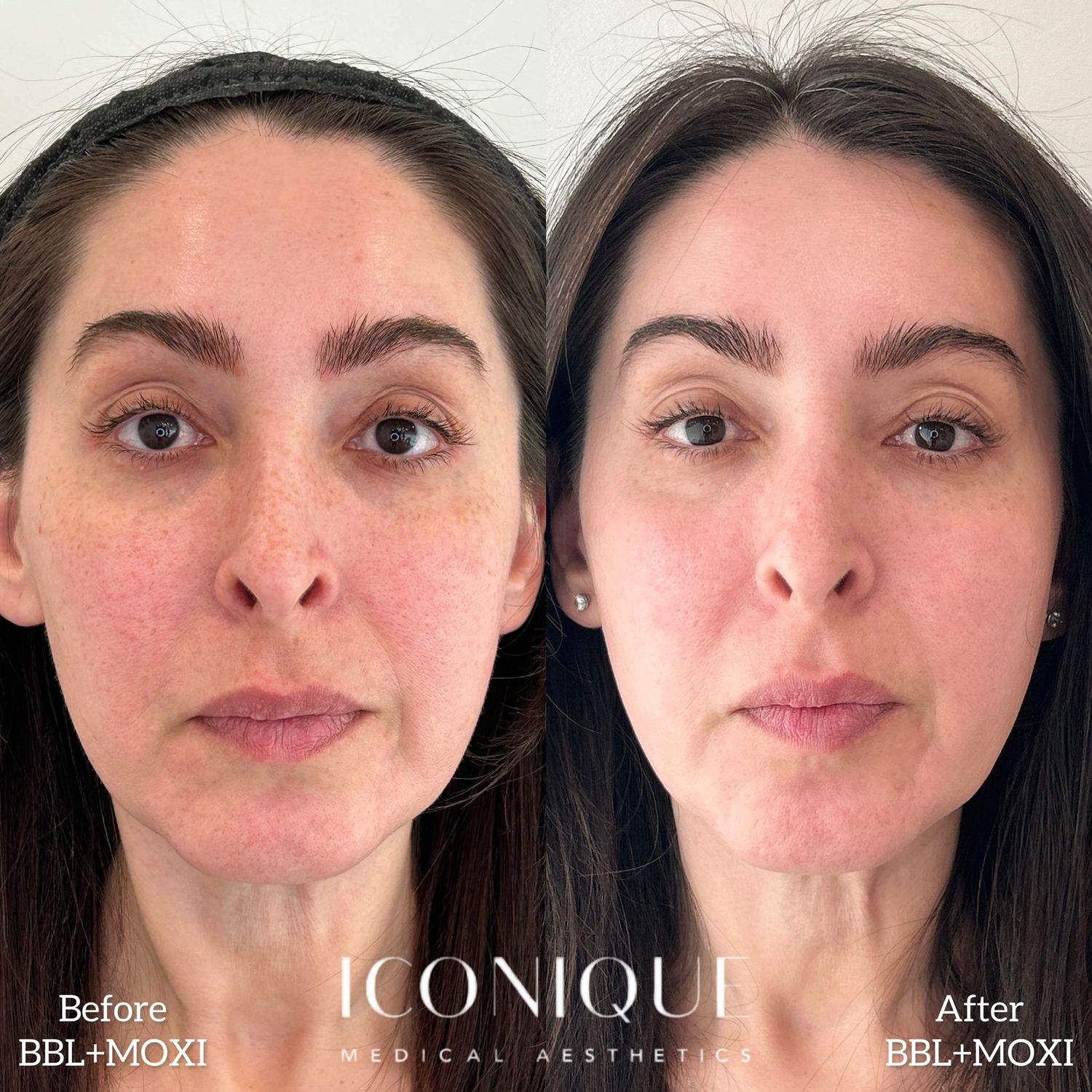 Laser Treatment Before & After