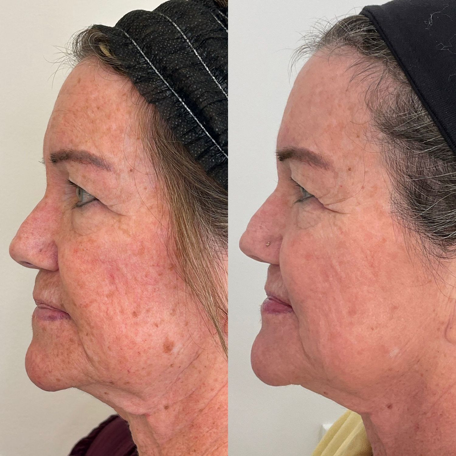 Laser Treatment Before & After