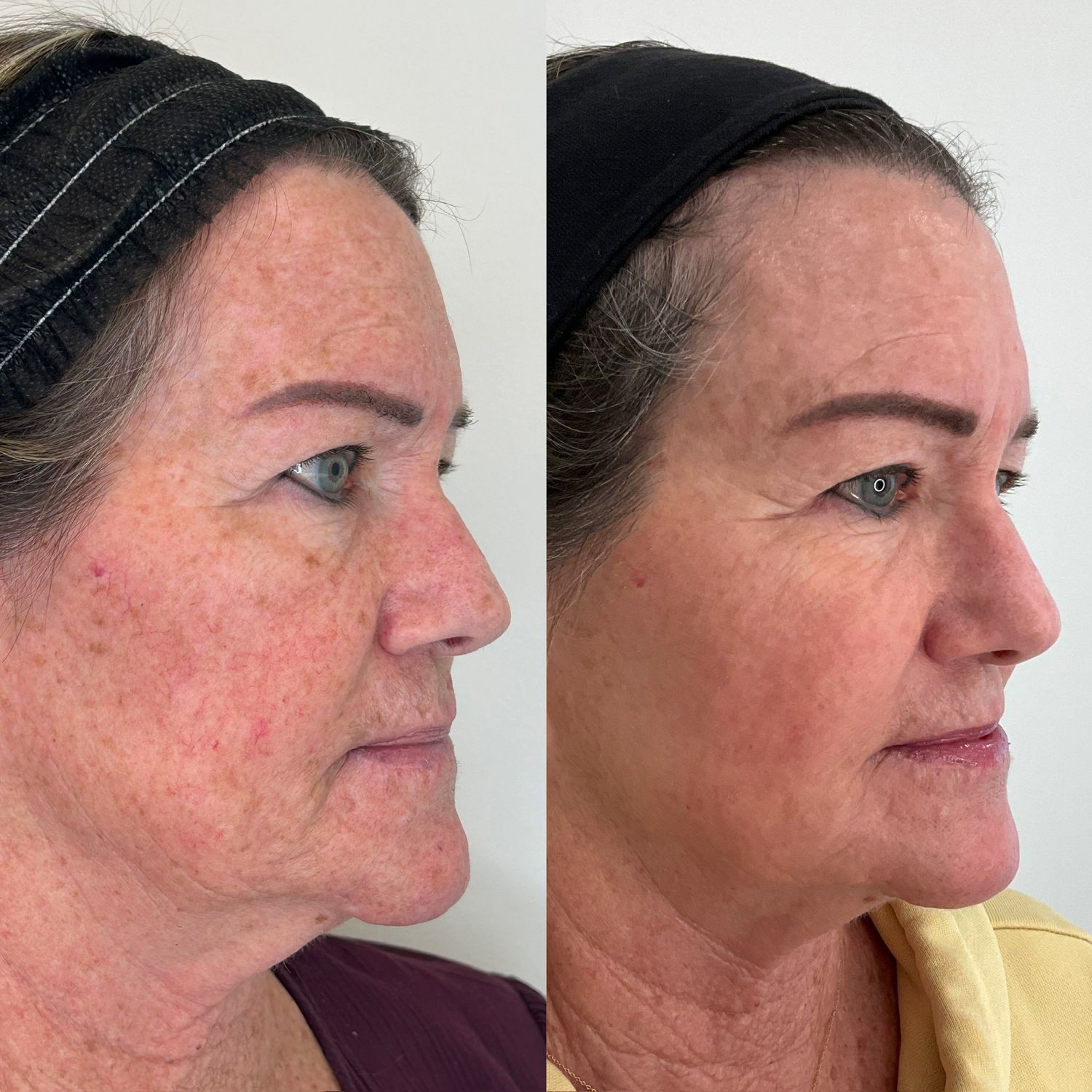 Laser Treatment Before & After