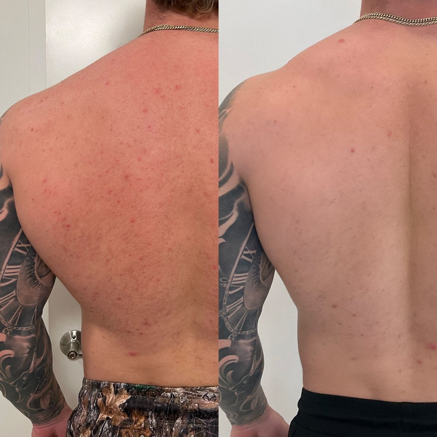 Laser Treatment Before & After