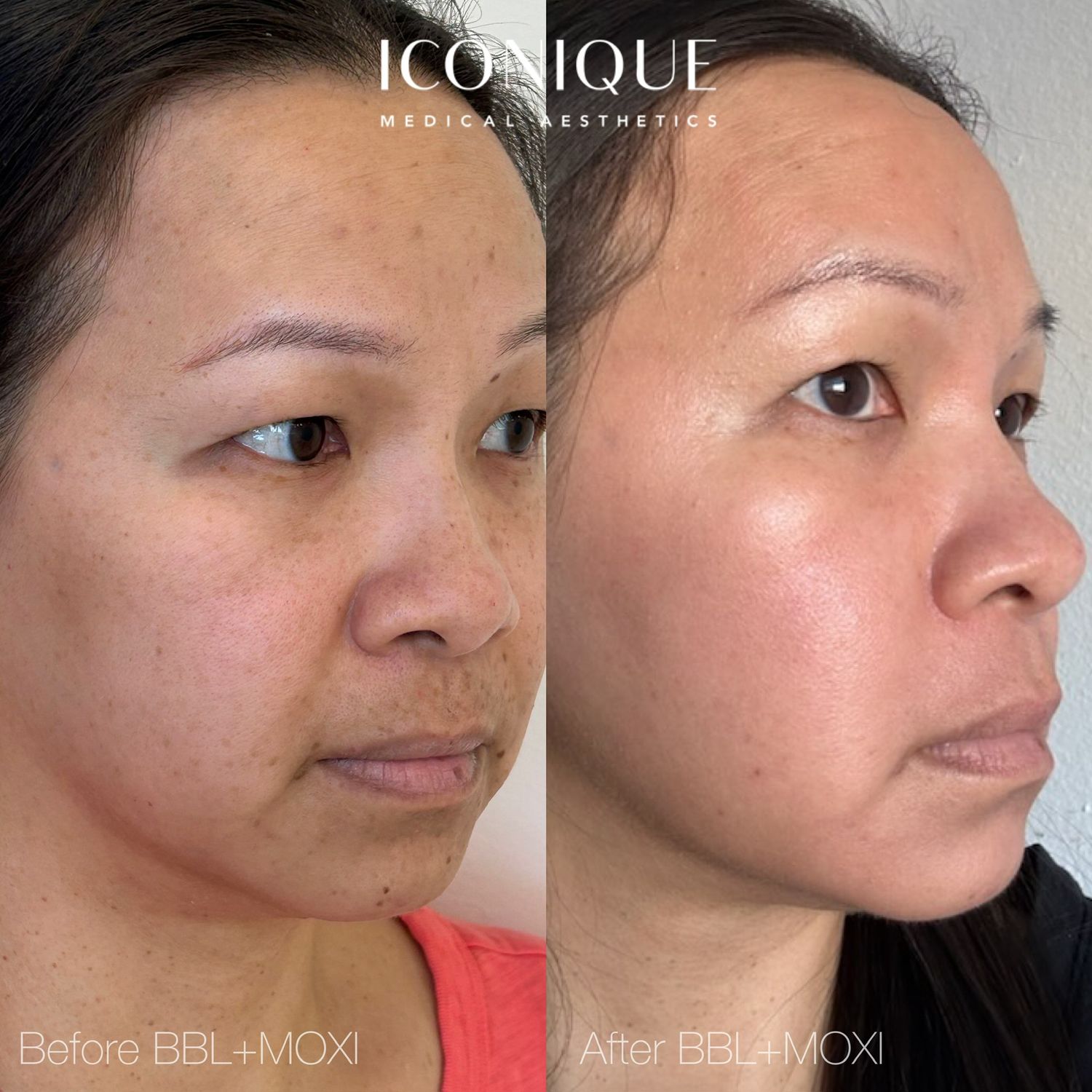 Laser Treatment Before & After