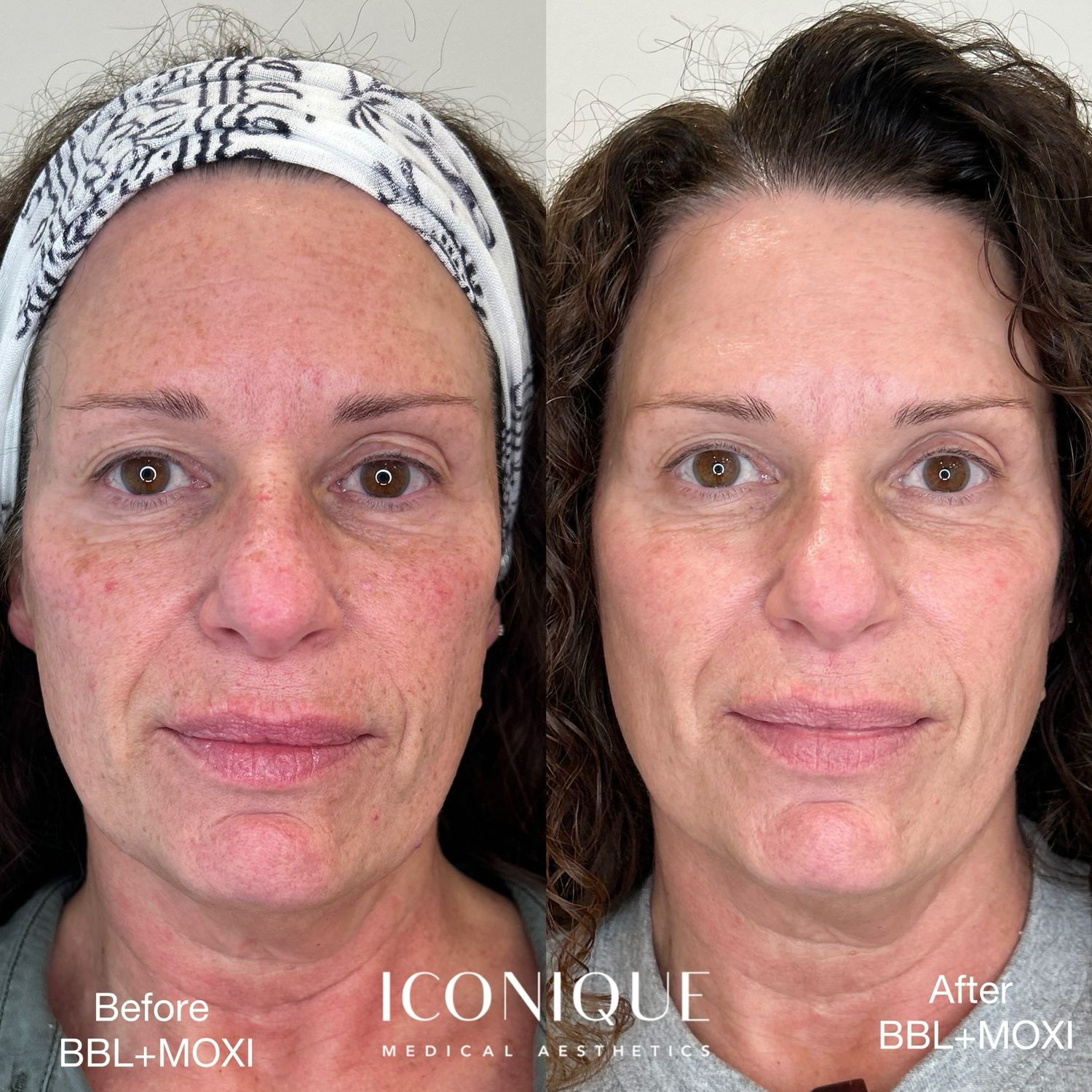 Laser Treatment Before & After