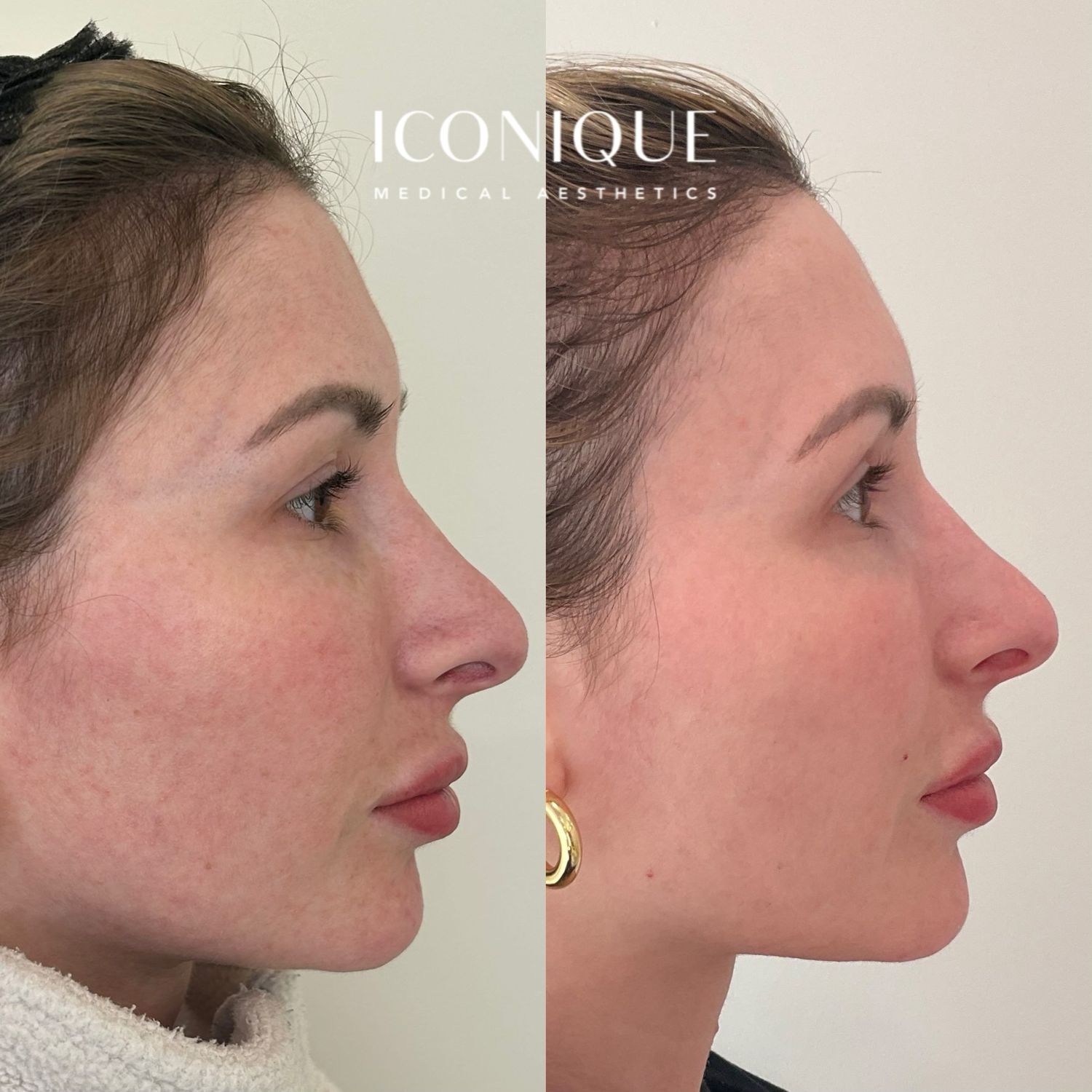 Laser Treatment Before & After