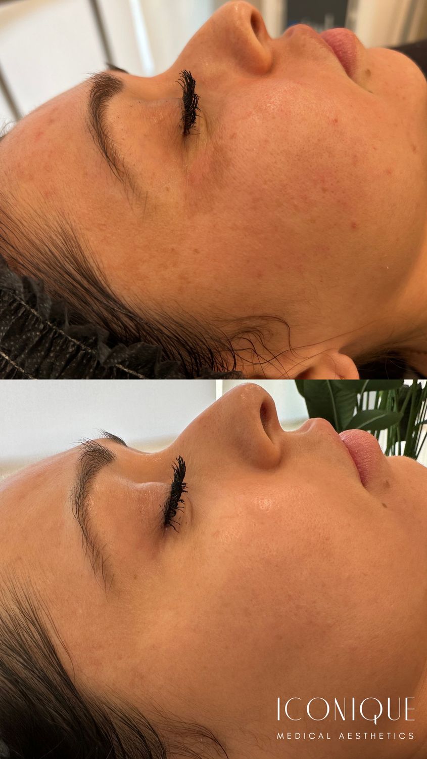 Laser Treatment Before & After
