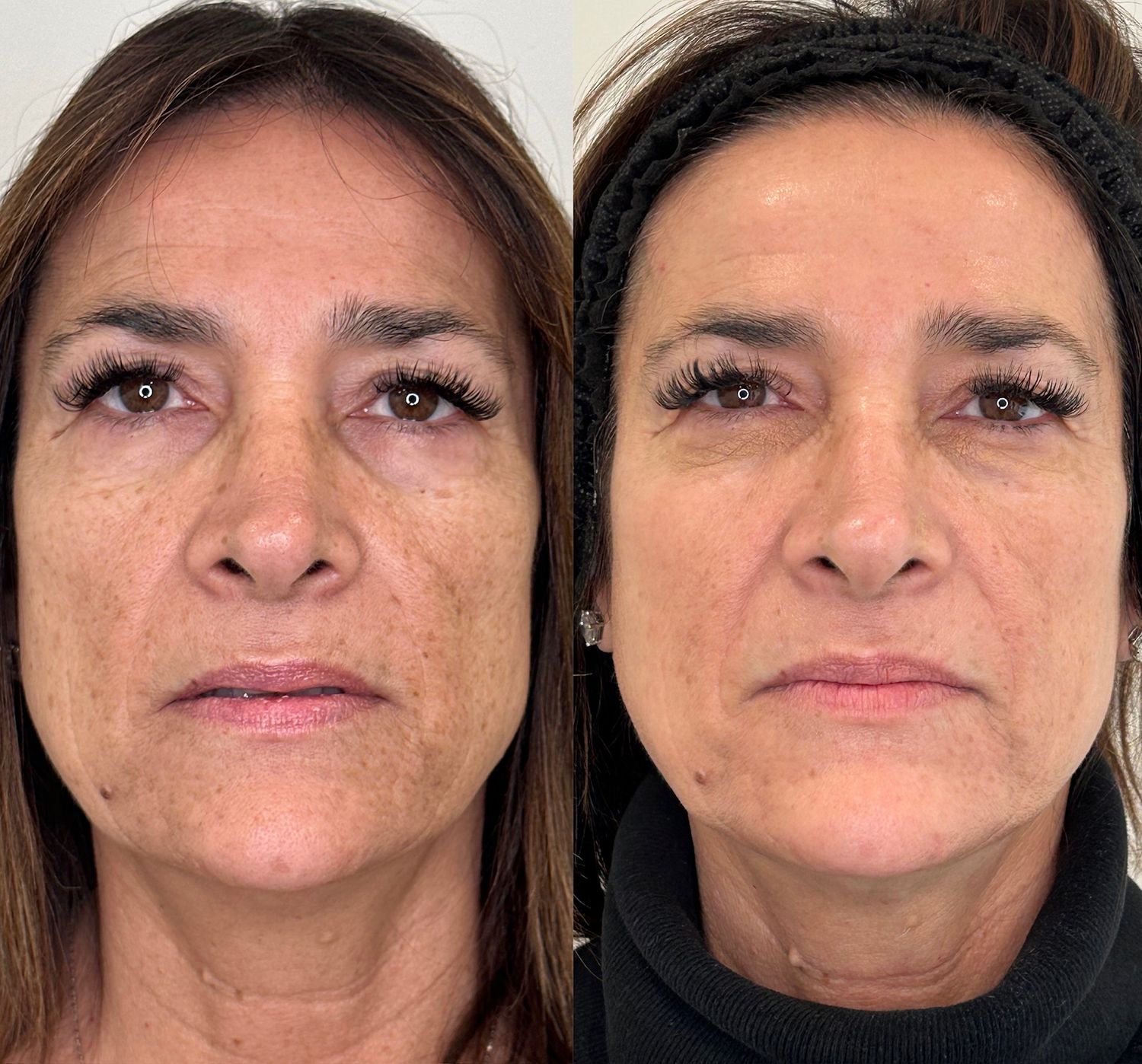 Laser Treatment Before & After