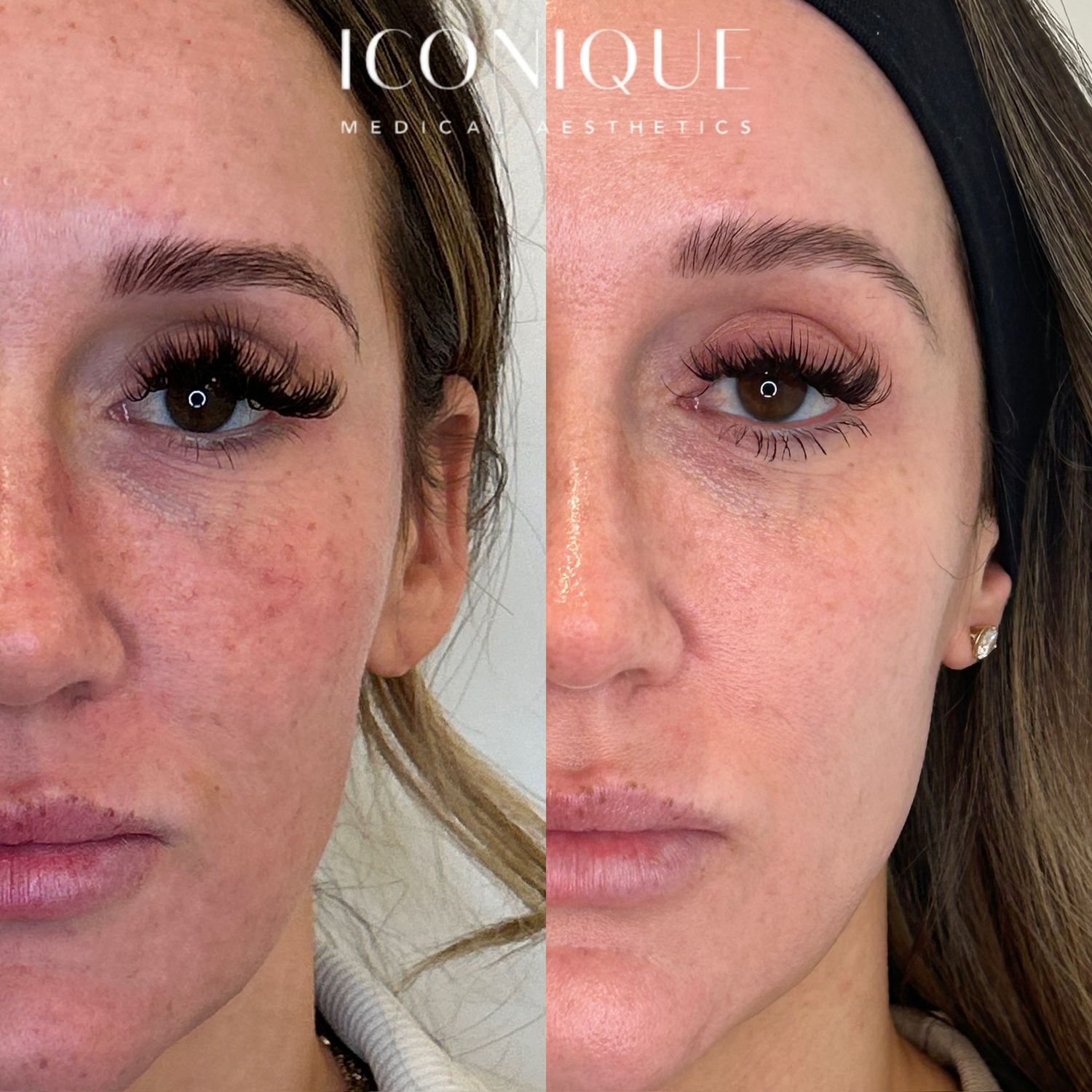 Laser Treatment Before & After