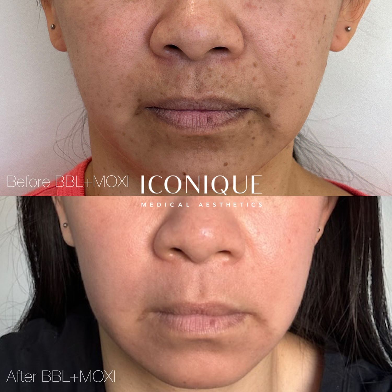 Laser Treatment Before & After