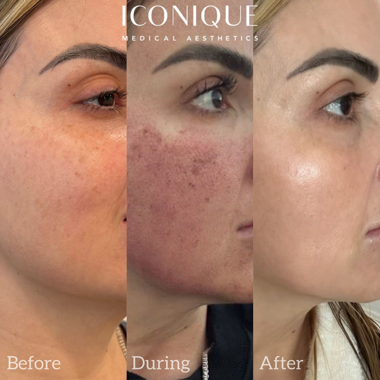 Laser Treatment Before & After