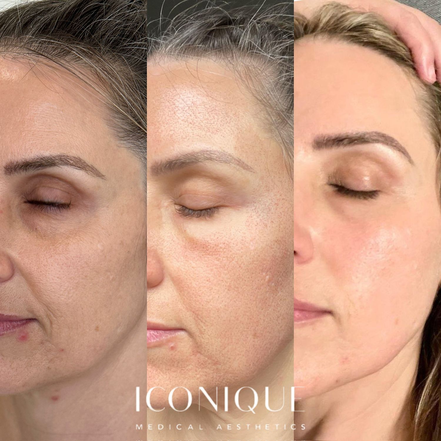 Laser Treatment Before & After