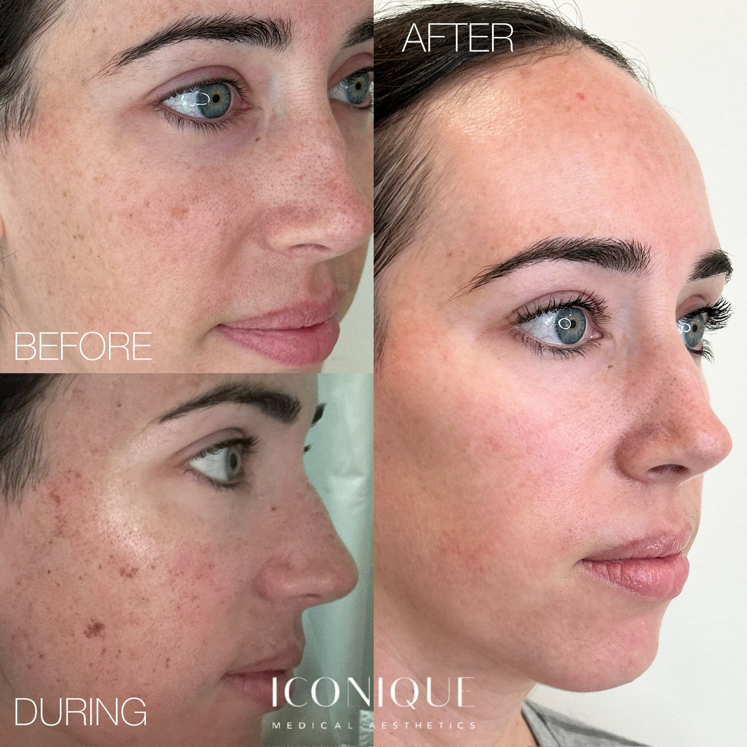 Laser Treatment Before & After