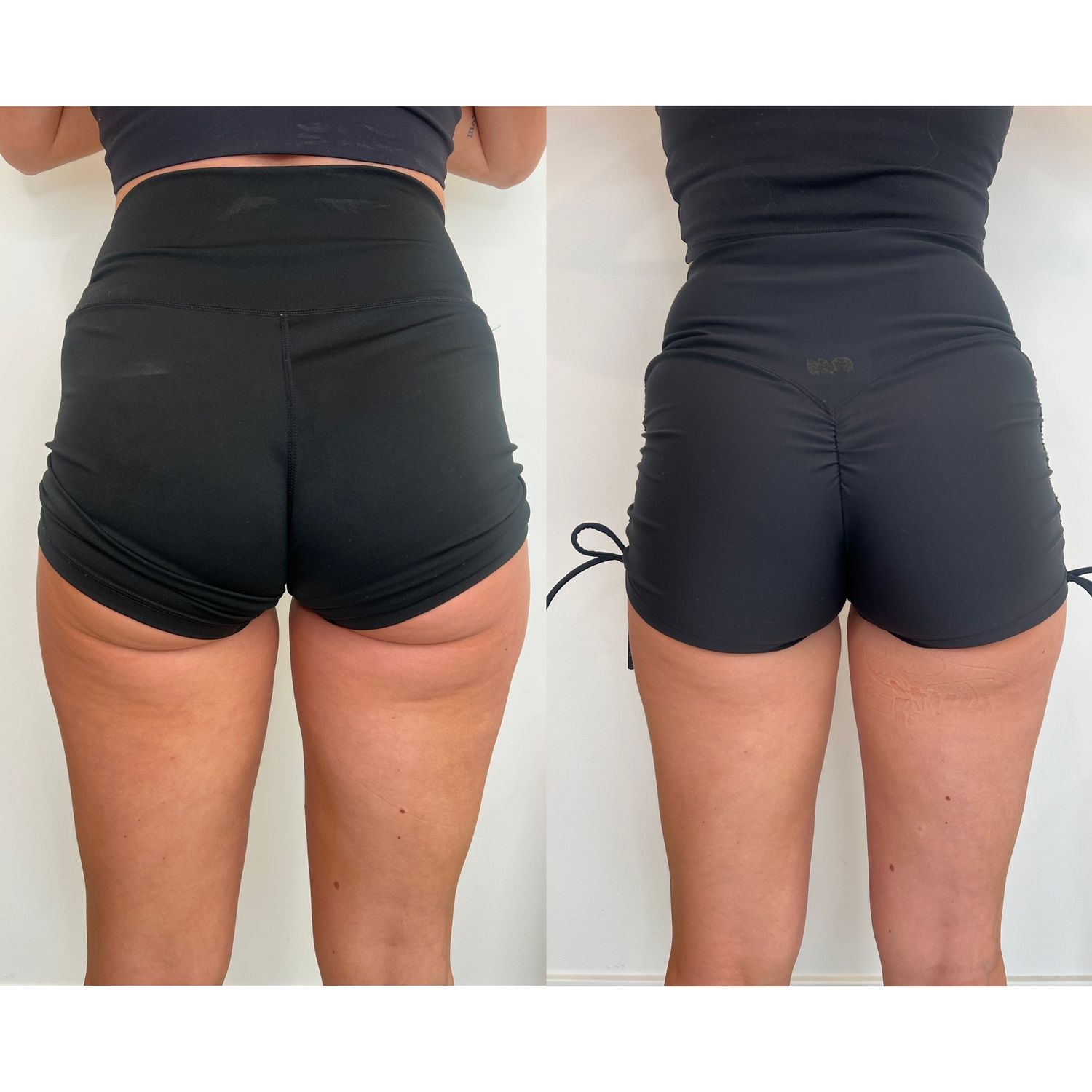 Laser Treatment Before & After