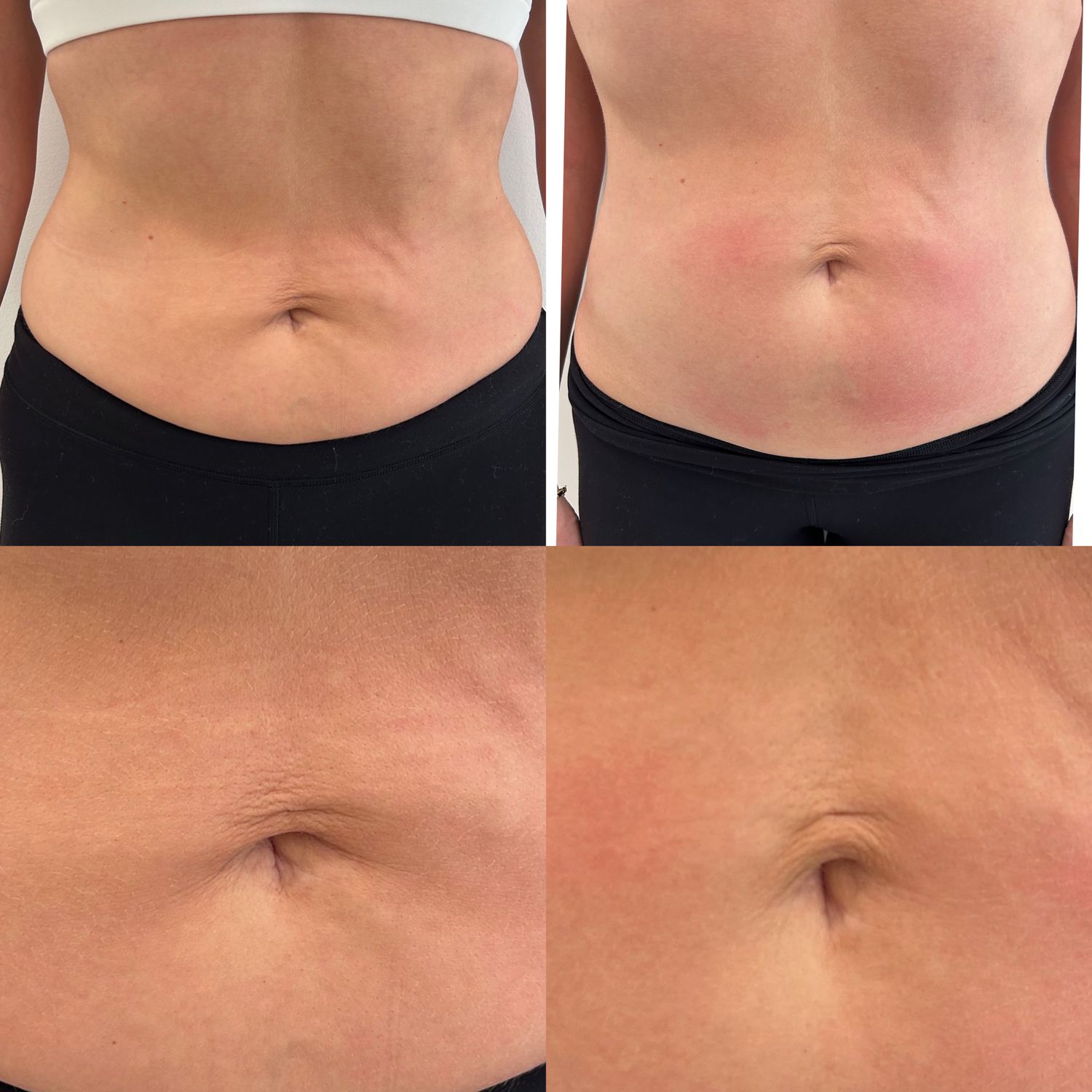 Laser Treatment Before & After