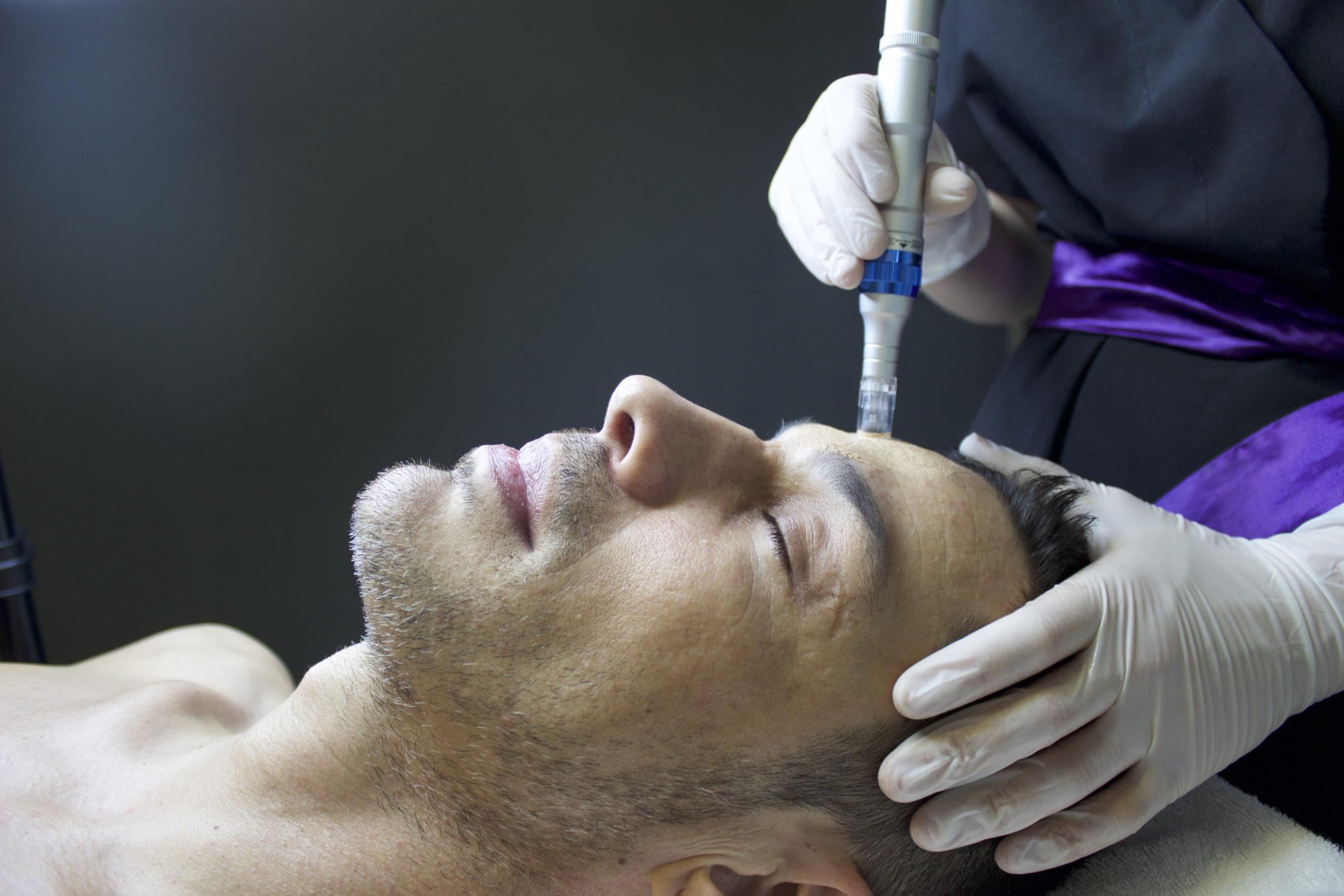 Is microneedling good for your skin