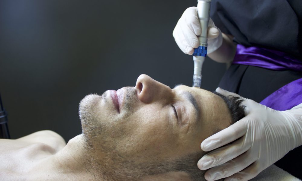 Is microneedling good for your skin